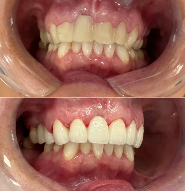Before and after - upper front teeth esthetic rehabilitation