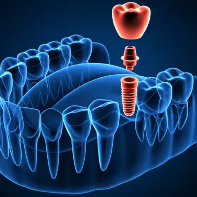 Dental implants and implantology