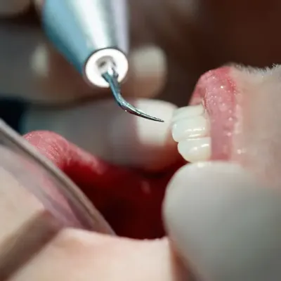 Oral hygiene and teeth cleaning